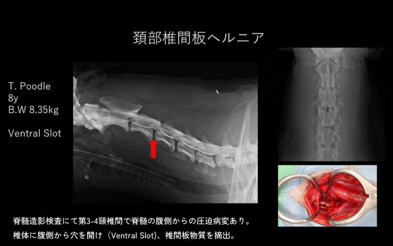 頸部椎間板ヘルニア