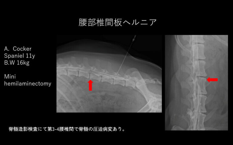 腰部椎間板ヘルニア