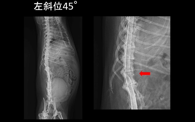 腰部椎間板ヘルニア