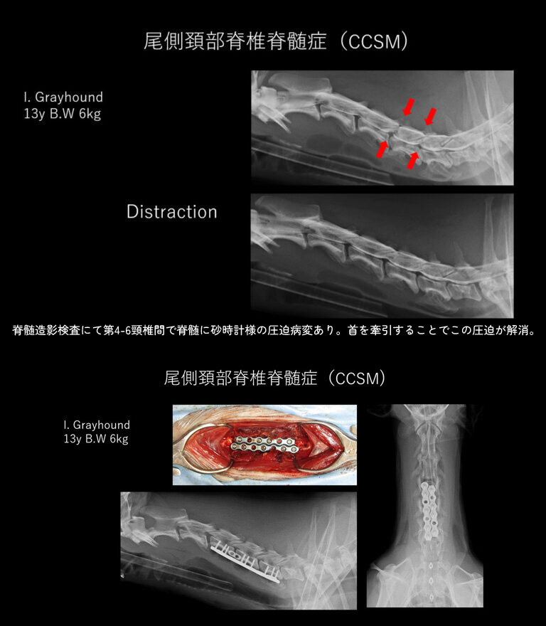 肩甲骨頚部骨折