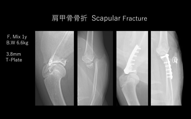 肩甲骨頚部骨折