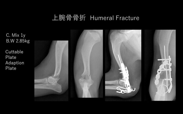 上腕骨顆上骨折