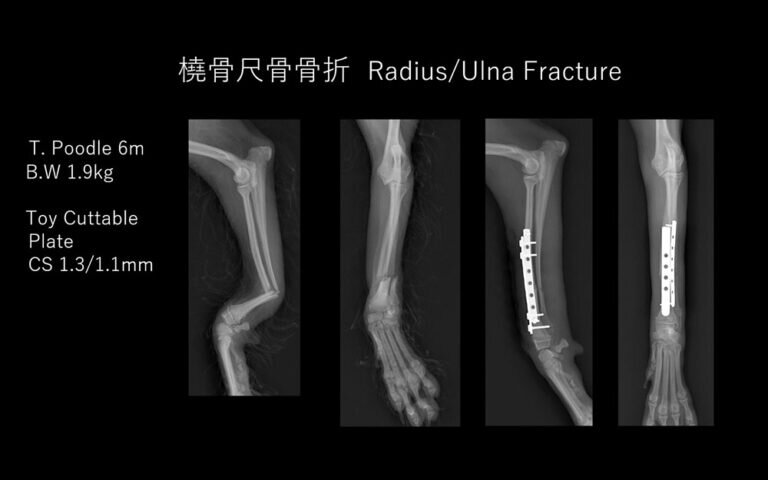 橈骨尺骨骨折