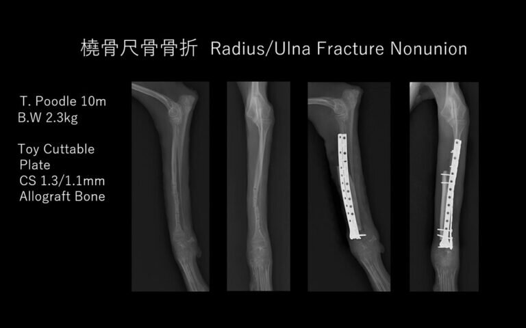 橈骨尺骨骨折癒合不全・同種移植骨使用