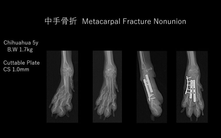 第3・4・5 中手骨骨折癒合不全