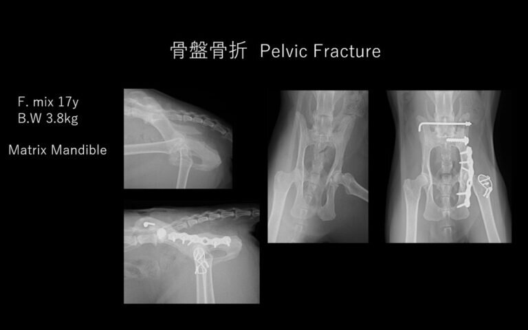 仙腸関節離断＋寛骨臼骨折