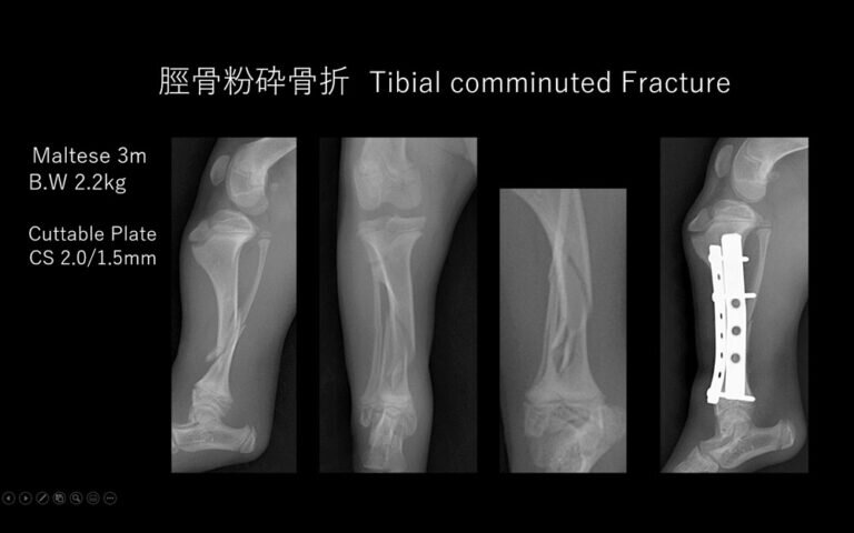 脛骨粉砕骨折