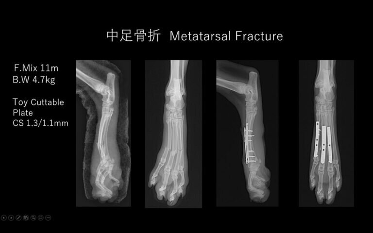 第3・4・5 中足骨骨折