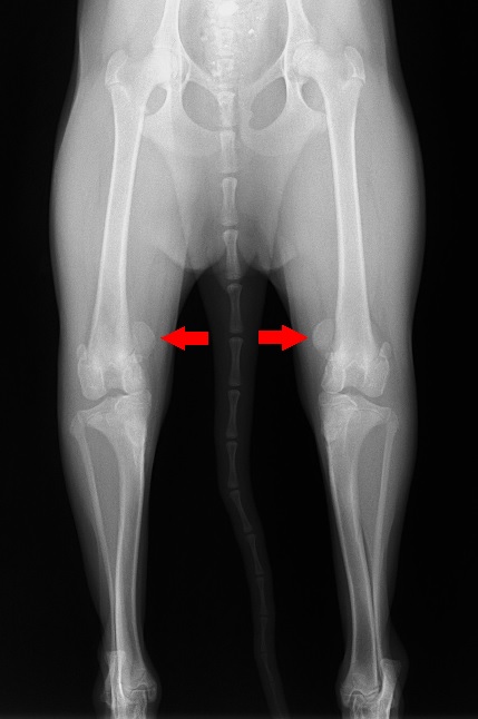 手術前　外れた膝蓋骨（膝のお皿）